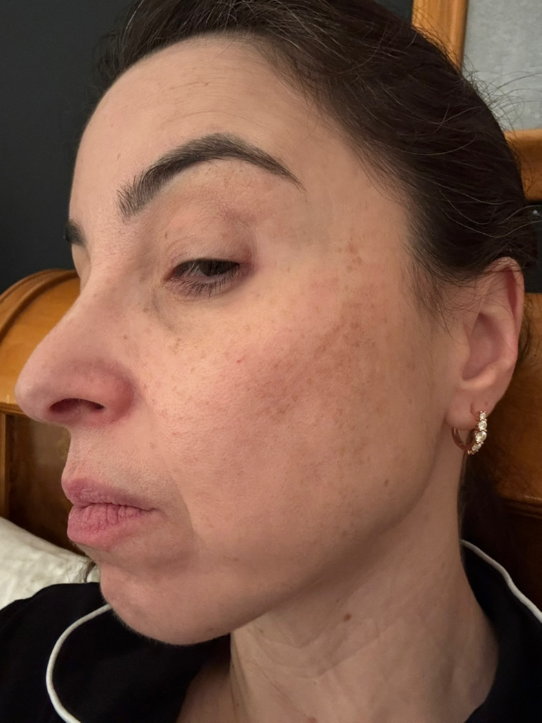 The Spot Peel review photo by Keli M.