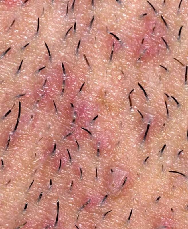 get-rid-of-ingrown-hair-musely