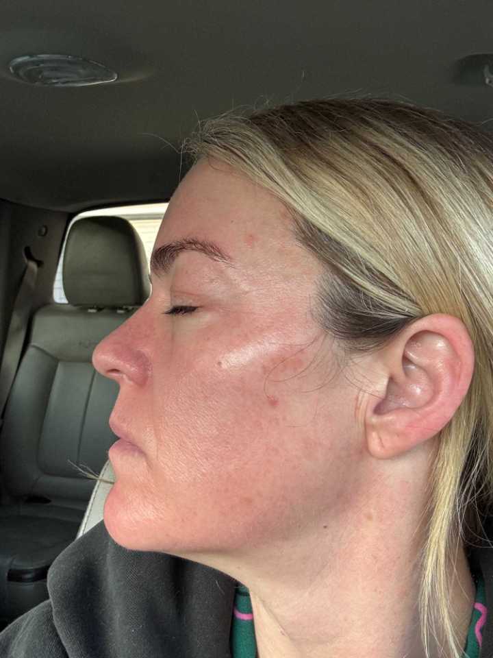 The Spot Peel review photo by SKPD D.