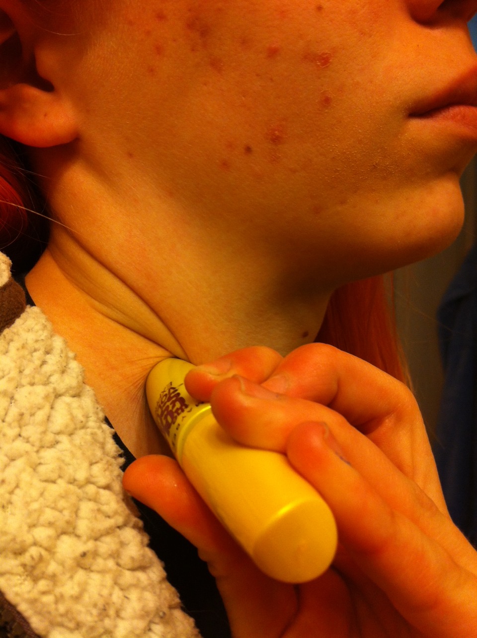 ways to treat a hickies in minutes off your lip