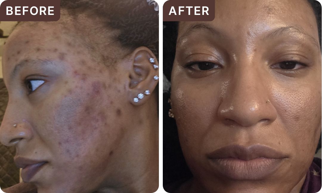 Caronda H. -- before and after, 8 weeks