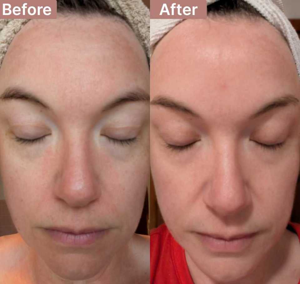 The Spot Peel review photo by Amanda M.