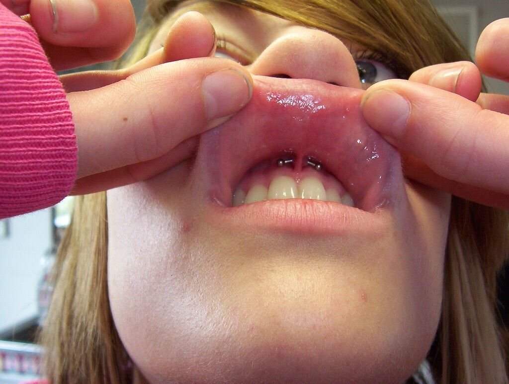 Infected smiley store piercing