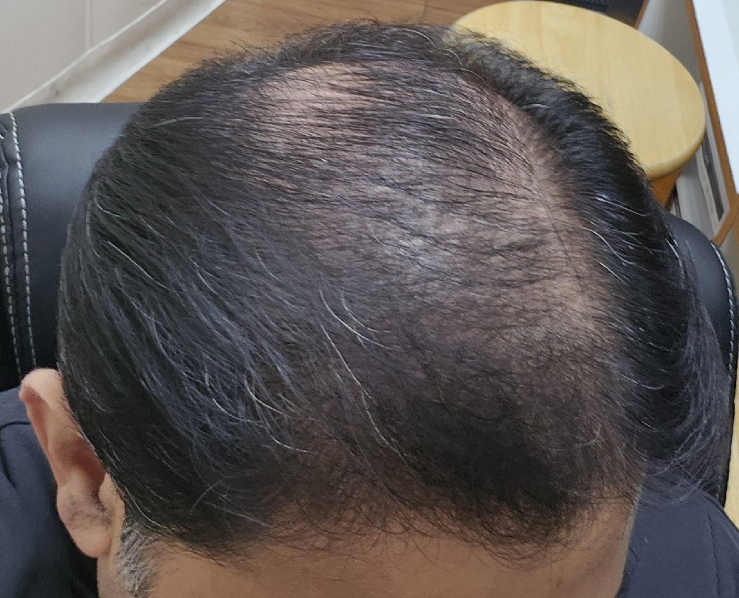 The Hair Topical Solution - Modern review photo by Patient M.