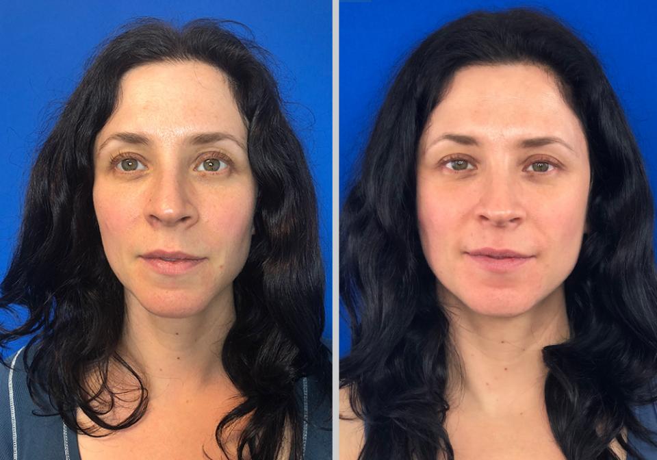 Melanie, 39
After just 2 months of use 


These transformations are from the result of Face-Rx.

See Face-Rx in the news: