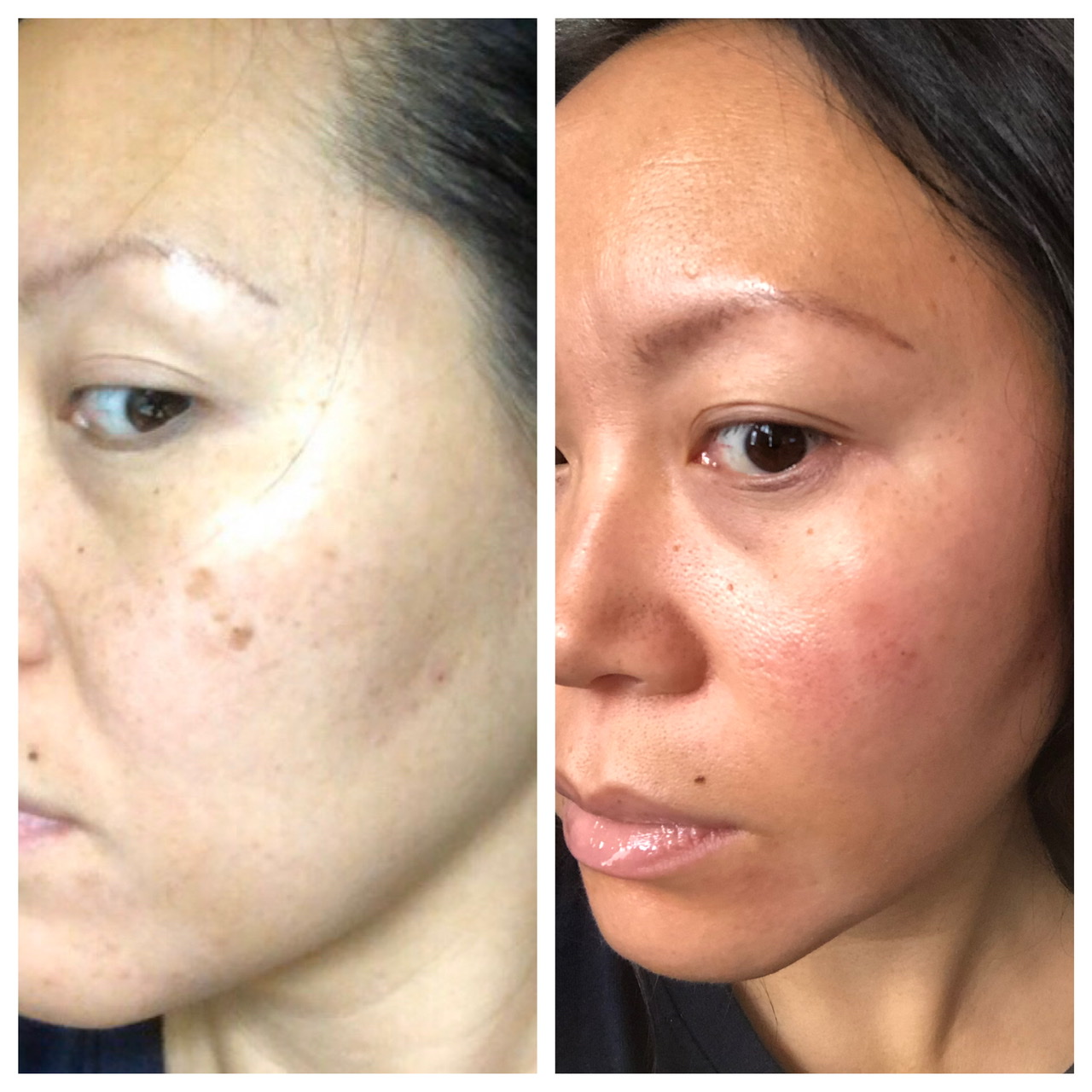 musely spot treatment