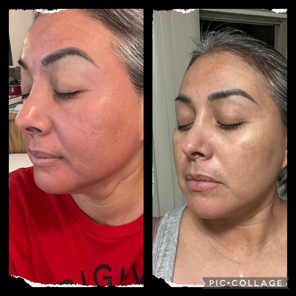 The Spot Peel review photo by Jessica N.