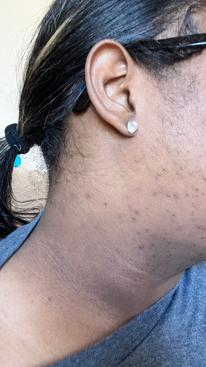 The Spot Peel review photo by Yauna F.